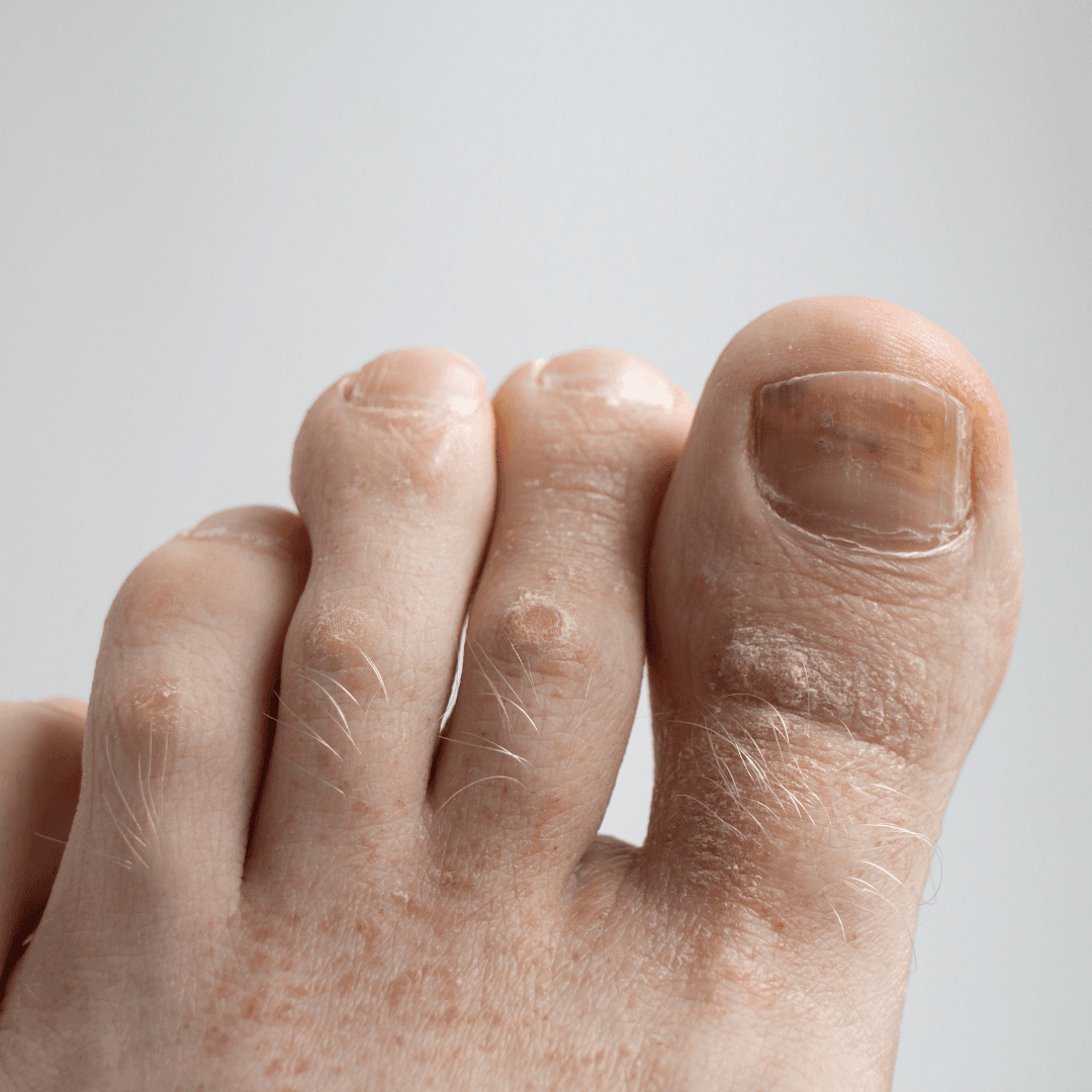 Toenail on day 1: thickened, brittle texture.