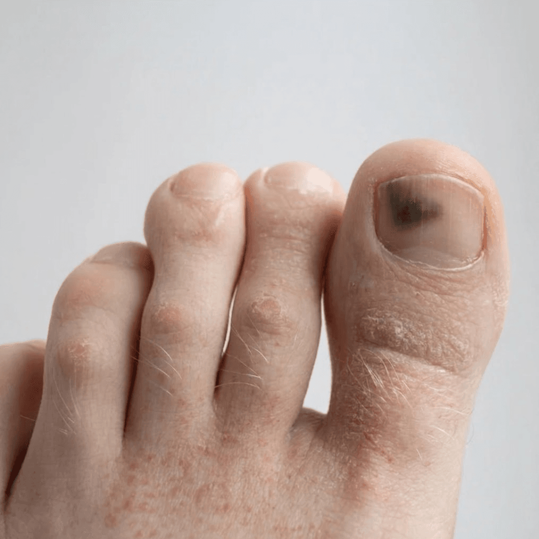 Toenail on day 15: smoother surface and conditioned cuticle.