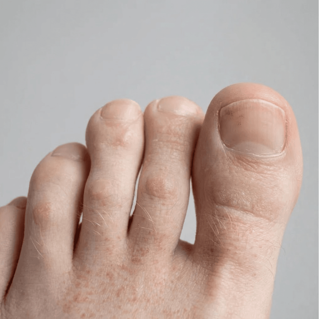 Toenail on day 30: clear, clean new growth.
