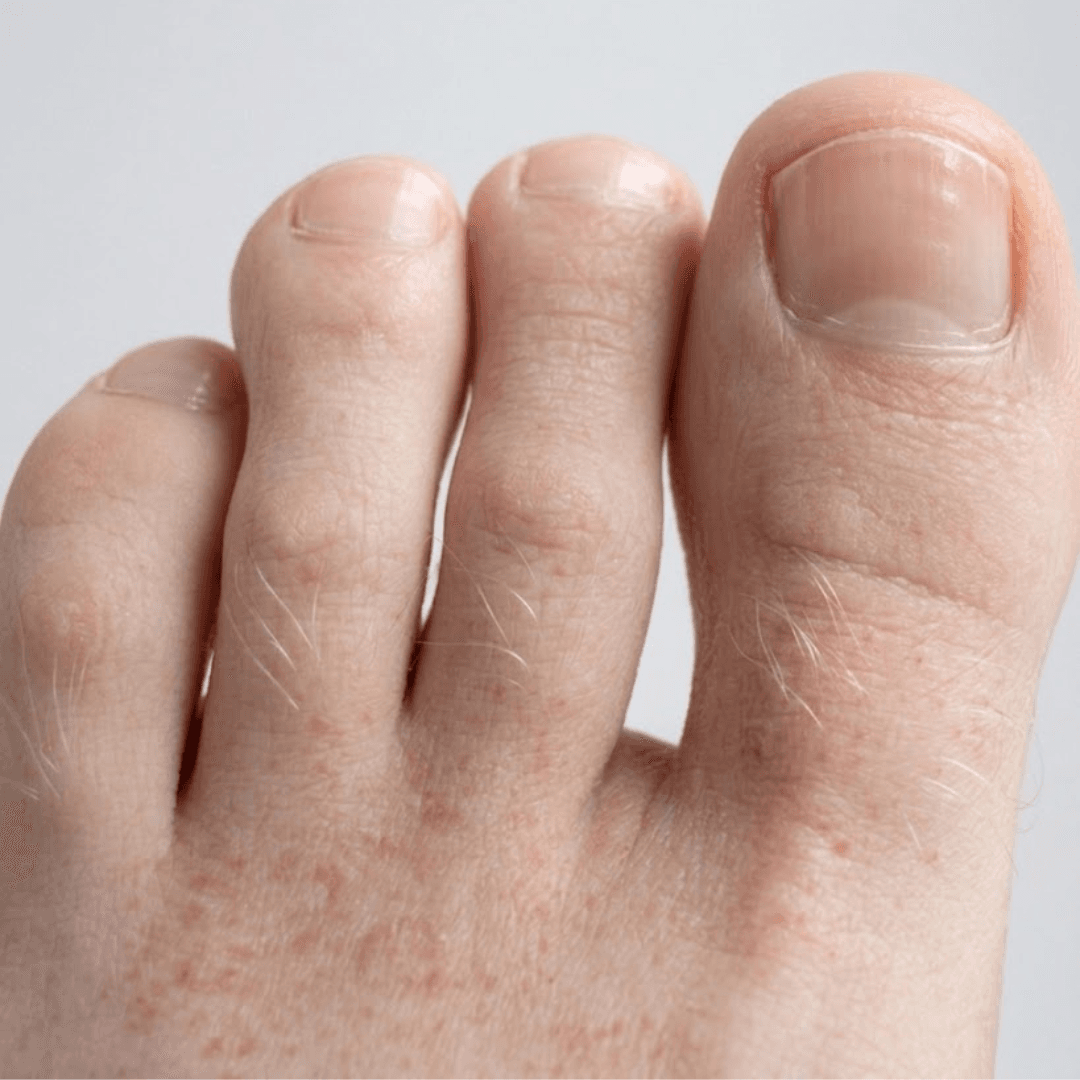 Toenail on day 45: hydrated, smooth and clear appearance.